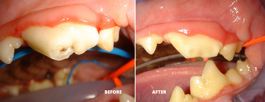 BEFORE & After: Root Canal