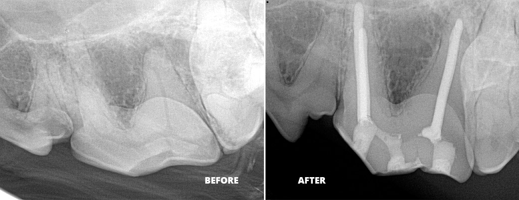 BEFORE & After: Root Canal X-ray